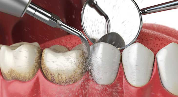 مراقبت های بعد از جرم گیری دندان