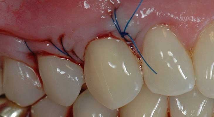 مراقبت های بعد از جراحی لثه