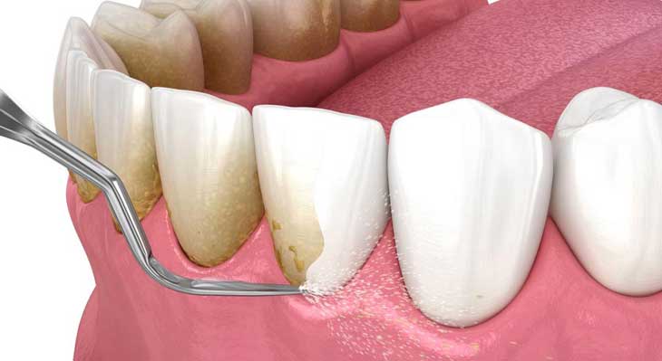 مراقبت های بعد از جرم گیری دندان