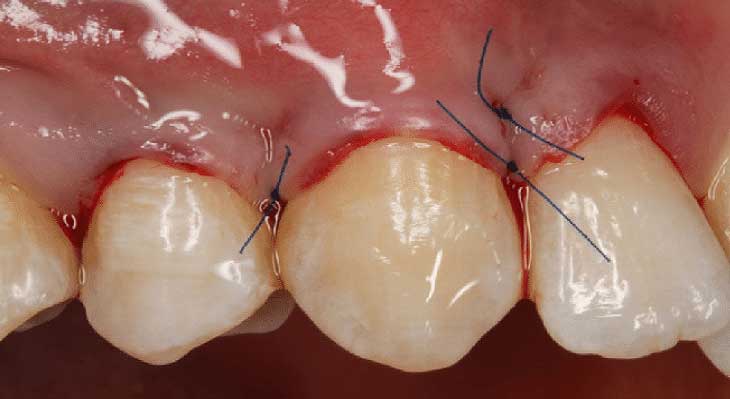 مراقبت های بعد از جراحی لثه