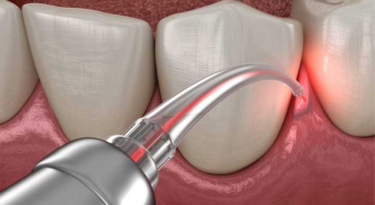 مراقبت های بعد از جراحی لثه