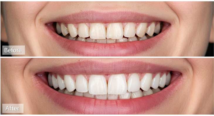 چرا کامپوزیت دندان زرد میشود؟