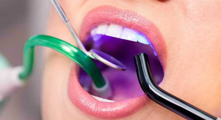 ساکشن دندانپزشکی