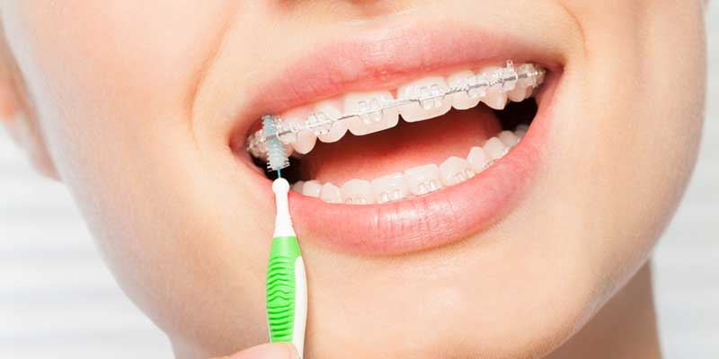 مراقبت های بعد از ارتودنسی دندان