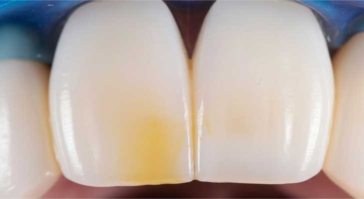 چرا کامپوزیت دندان زرد میشود؟