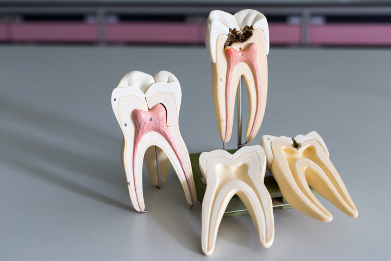 عوارض ایمپلنت دندان یا عصب کشی
