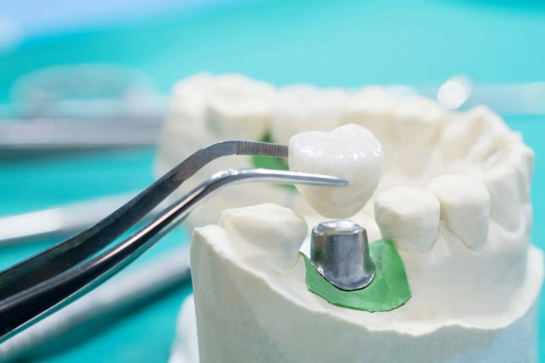 روش های مراقبت از روکش دندان