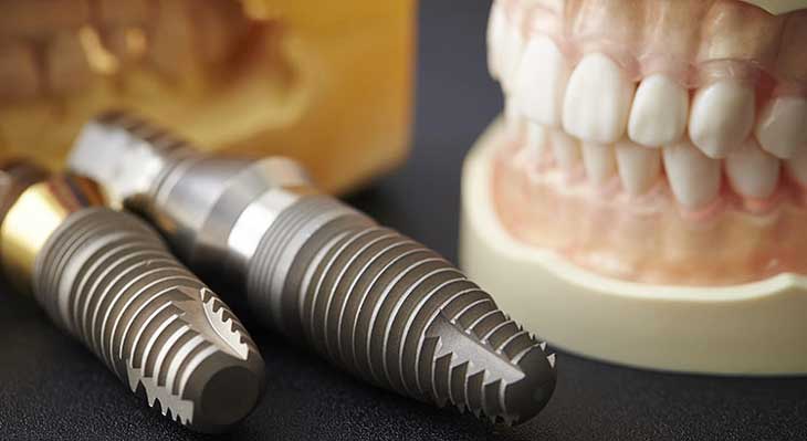 انواع ایمپلنت های کره ای