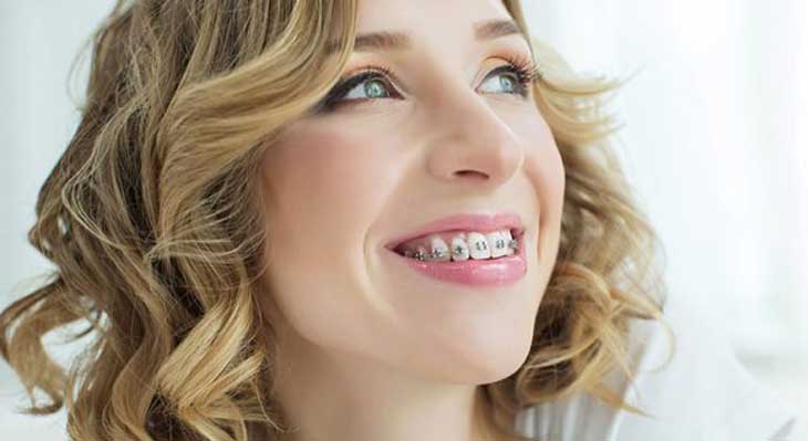 انواع ارتودنسی دندان