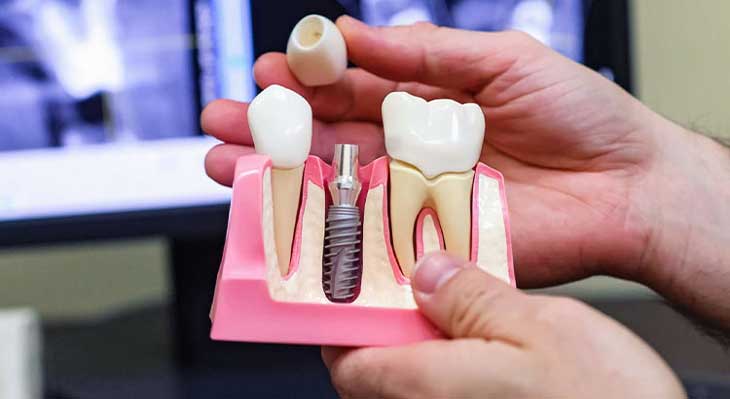 انواع ایمپلنت های کره ای