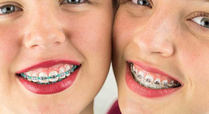 انواع ارتودنسی دندان