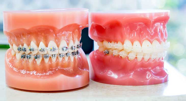 انواع ارتودنسی دندان