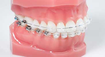 ارتودنسی-ثابت-سرامیکی