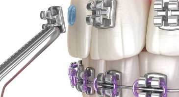 ارتودنسی-ثابت-فلزی