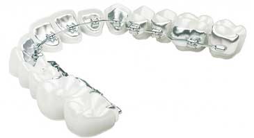 ارتودنسی-ثابت-لینگوال