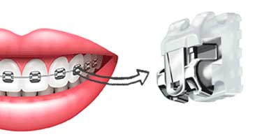 ارتودنسی-ثابت-دیمون