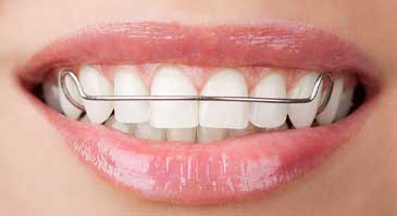 ارتودنسی-متحرک-نگهدارنده-یا-ریتیتنر