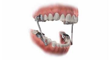 ارنودنسی-متحرک-دستگاه-فانکشنال