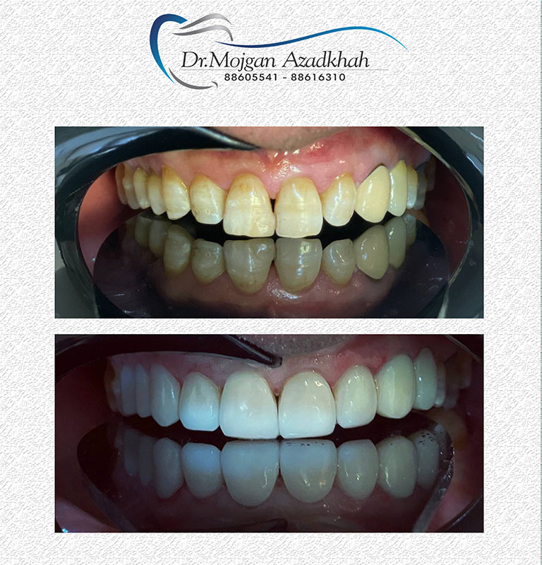 The Complete Process of orthodontic treatment Dwarka