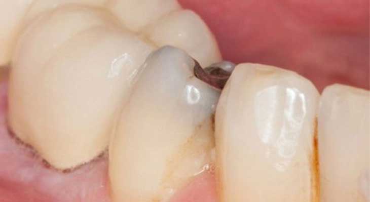 پوسیدگی دندان