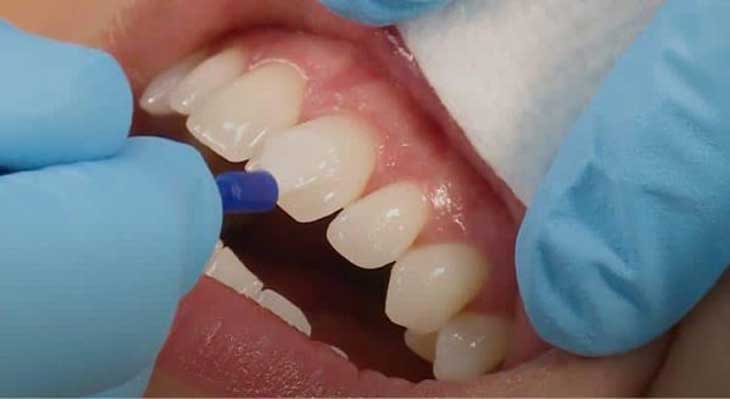 فلوراید تراپی چیست؟