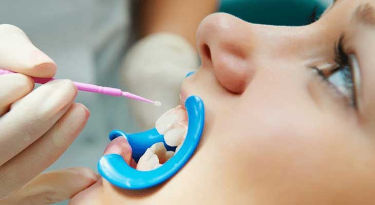 فلوراید تراپی چیست؟