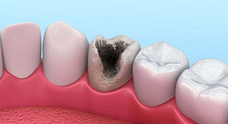 پوسیدگی دندان