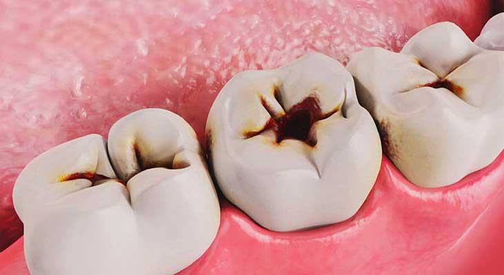 پوسیدگی دندان