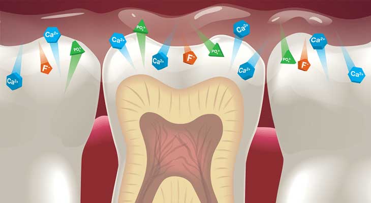 فلوراید تراپی چیست؟
