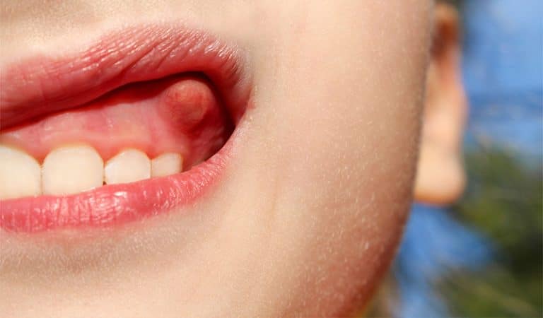 آبسه-دندان و علائم آن
