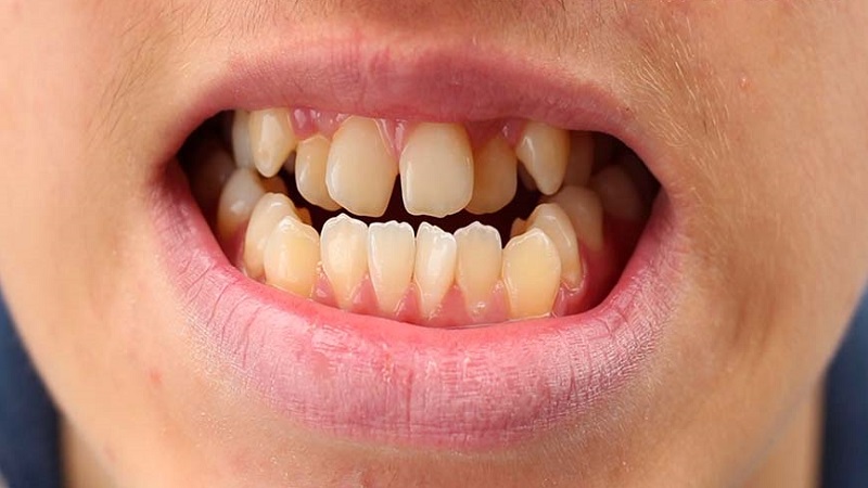 علت کج شدن دندان ها در کودکان