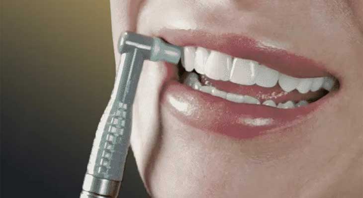 پولیش کامپوزیت دندان