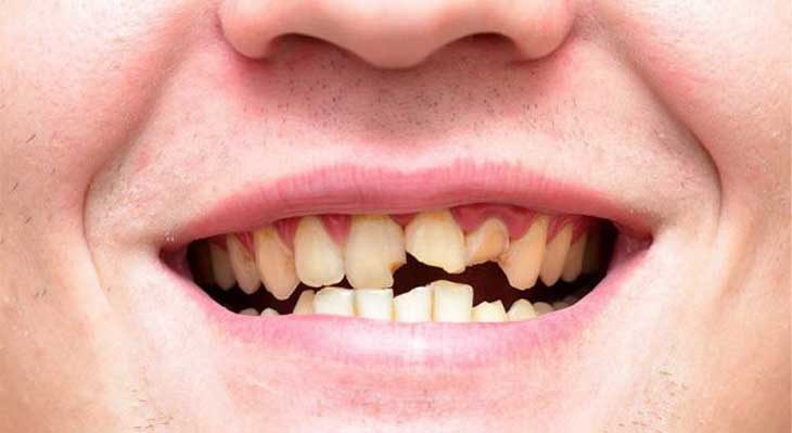 ترمیم دندان شکسته