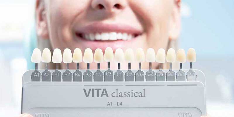 تفاوت رنگ دندان A1 و B1