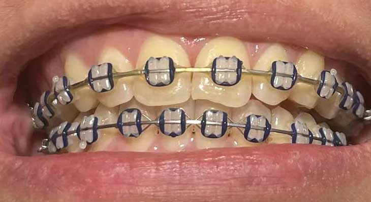 زرد شدن دندان بعد از ارتودنسی