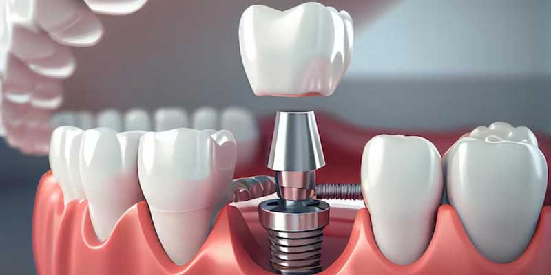 اباتمنت دندان