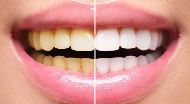 زرد شدن دندان بعد از ارتودنسی