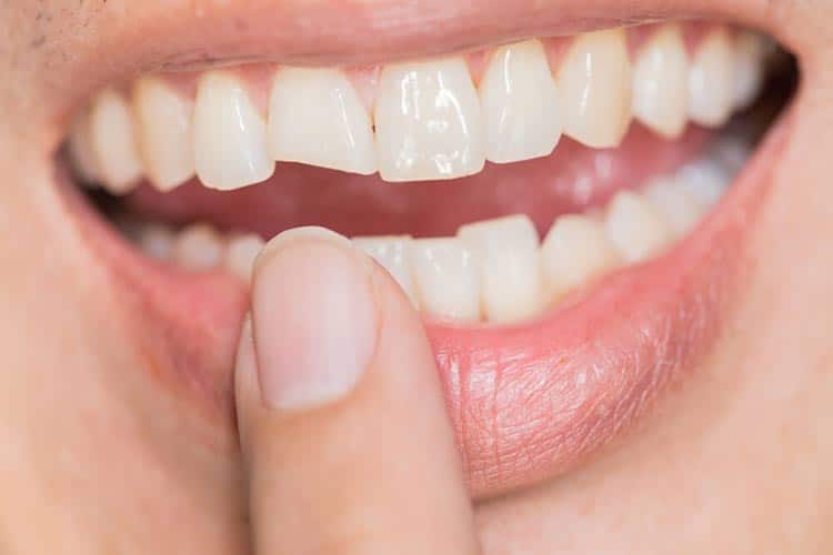 انواع شکستگی دندان و علت های آن