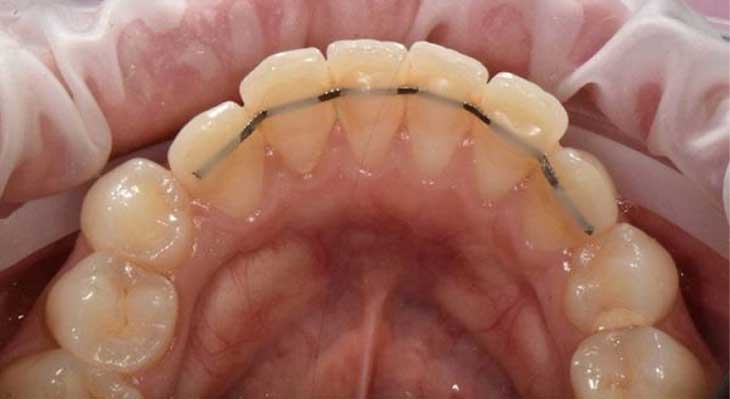 اسپلینت دندان چیست؟