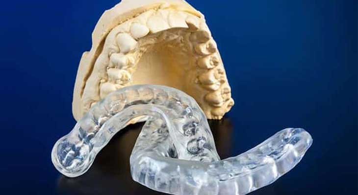 اسپلینت دندان چیست؟