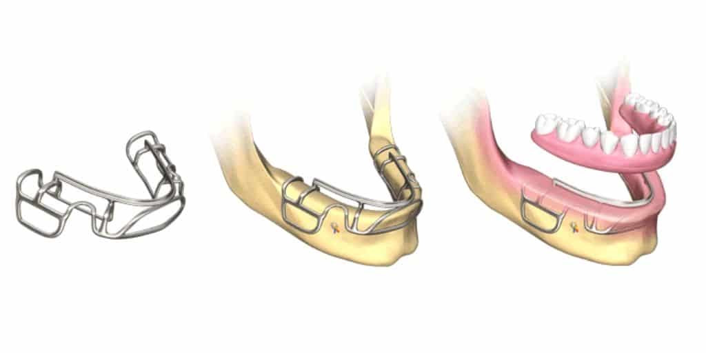 ایمپلنت های دندانی زیر پریوستئال