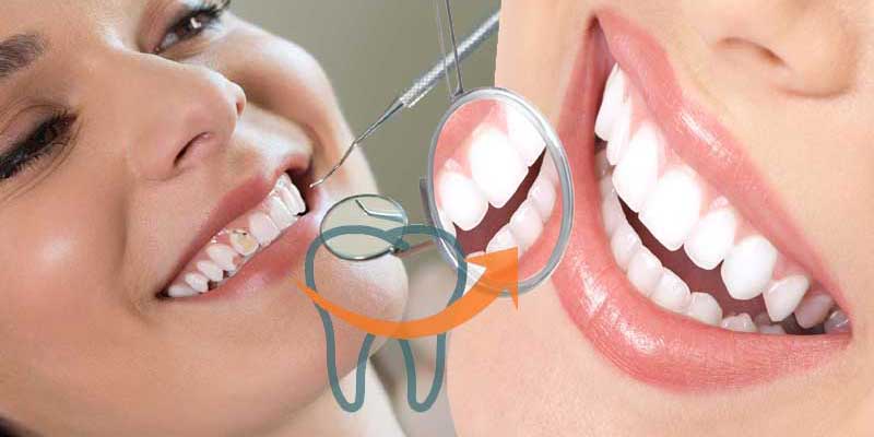 اصلاح طرح لبخند