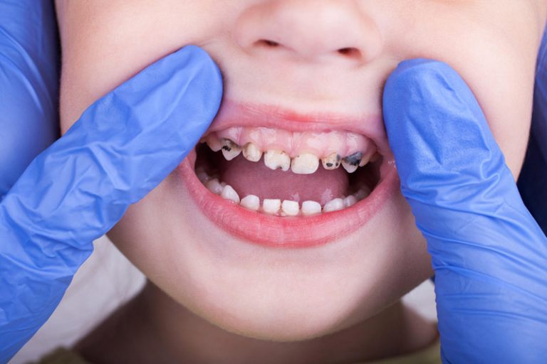 تاثیر ژنتیک بر پوسیدگی دندان ها