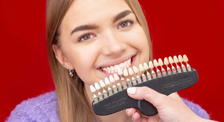 رنگ لمینت دندان ها