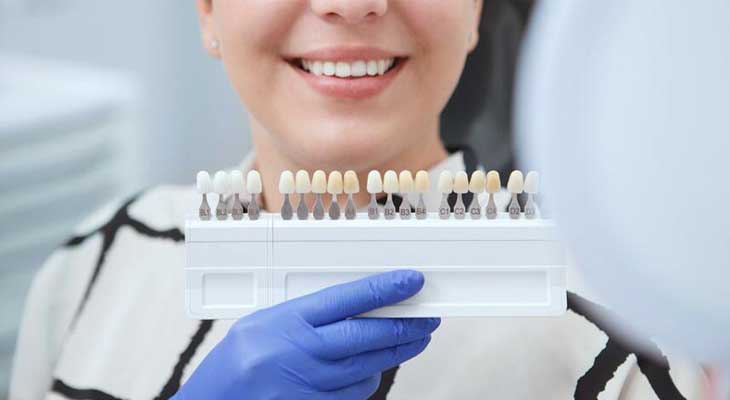 گروه های رنگی لمینت دندان