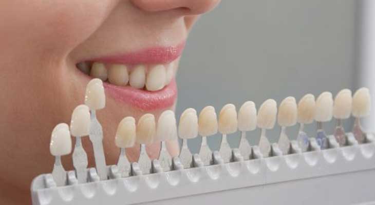 رنگ لمینت دندان