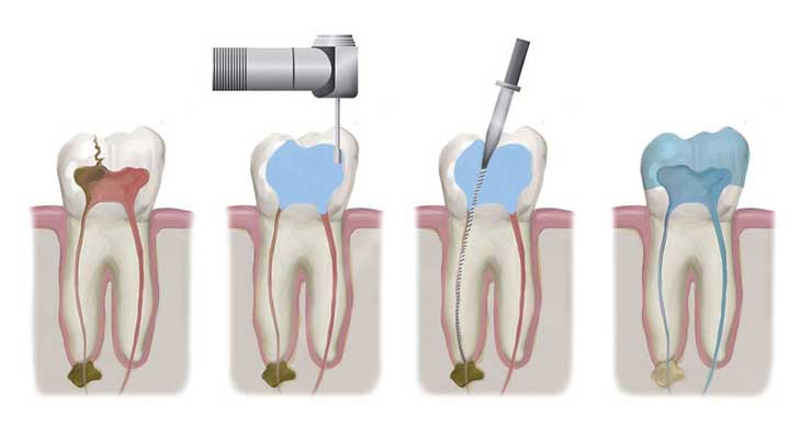 بهترین دکتر عصب کشی دندان در تهران