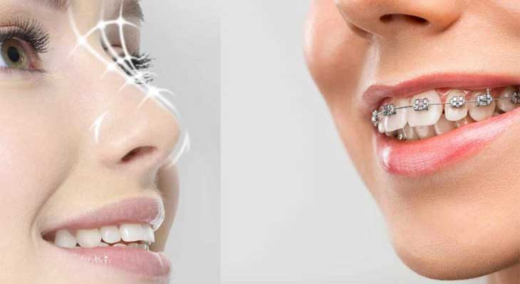 ارتودنسی و جراحی بینی