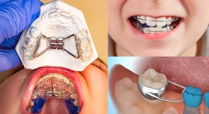 ارتودنسی پیشگیرانه