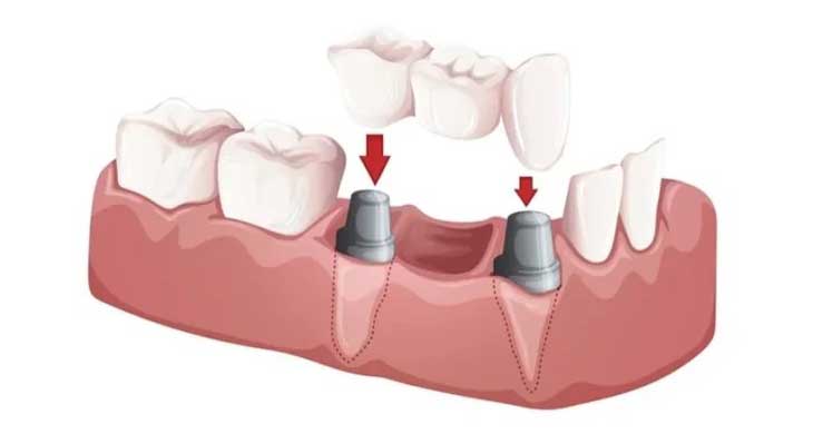 بریج های دندانی